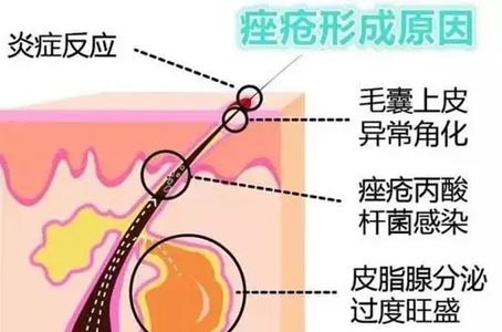 青春痘原因|郑州祛痘专业医院：为什么青春痘反复