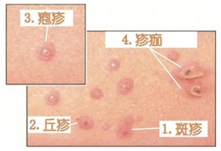 水痘症状形成过程