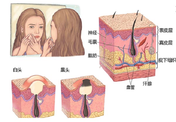 痤疮反反复复什么时候是个头?2023郑州皮肤病医院推荐