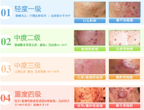 痤疮反反复复什么时候是个头?2023郑州皮肤病医院推荐